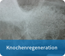 knochenregeneration